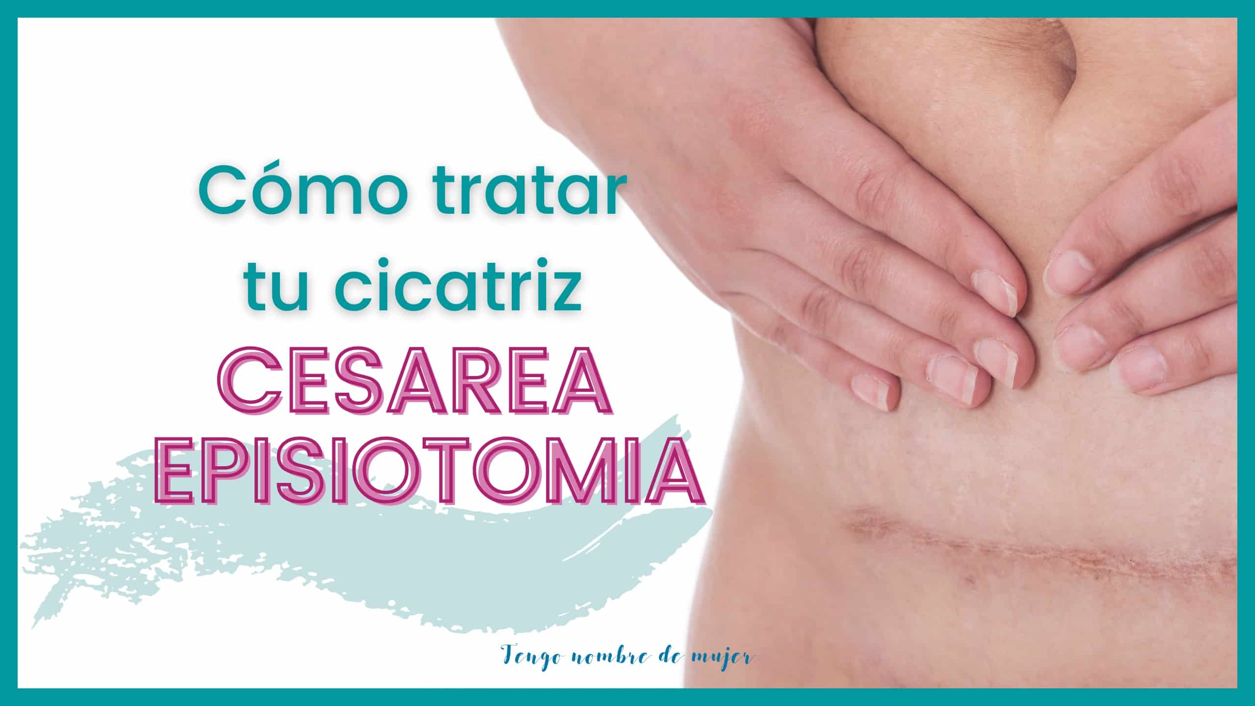 Cómo tratar tu cicatriz de cesárea o episiotomía? - TNDM