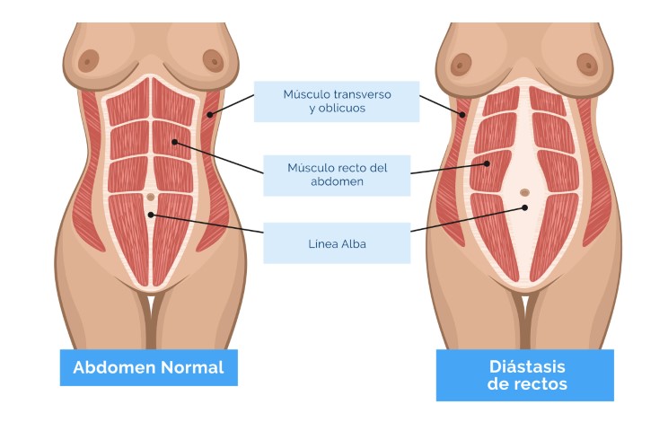 ¿Qué es la diástasis abdominal?